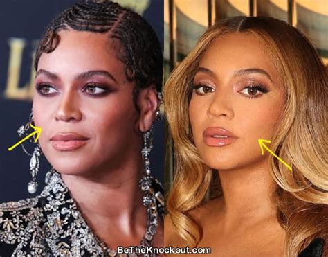 Did Beyoncé Have Plastic Surgery?